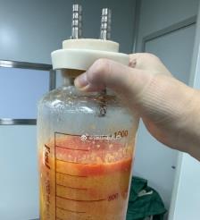 邵阳县水动力吸脂手术要做多久？